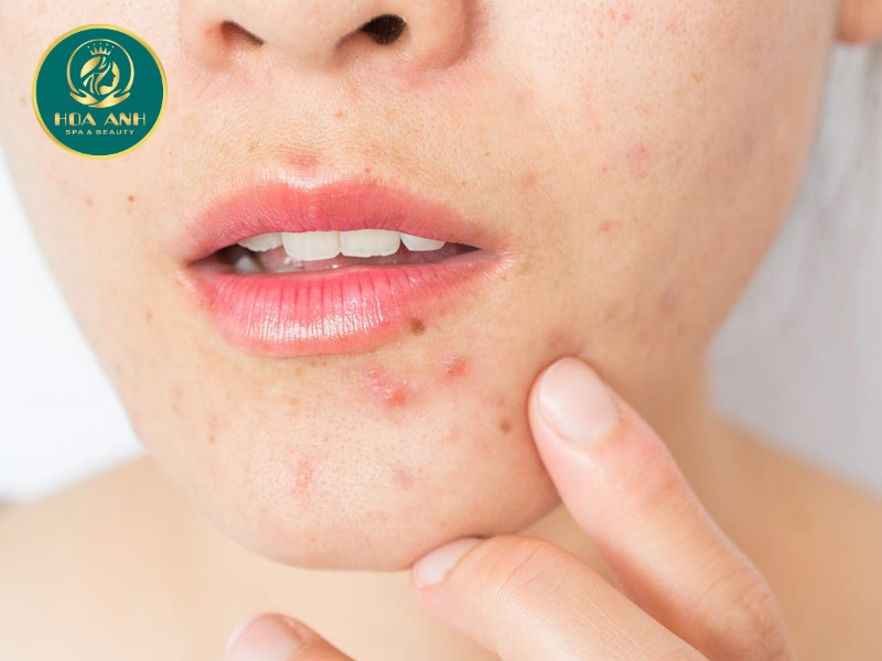 Vitamin A trị mụn trứng cá có tốt không